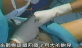 人流手术视频,真实视频解析